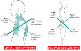 crossed syndrome