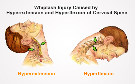 whiplash diagram