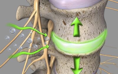 Herniated, Bulging, or Slipped Disc? What the Difference Means for Your Back Pain
