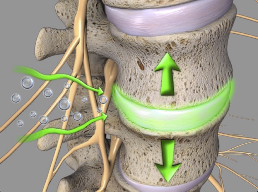spinal-decompression-2