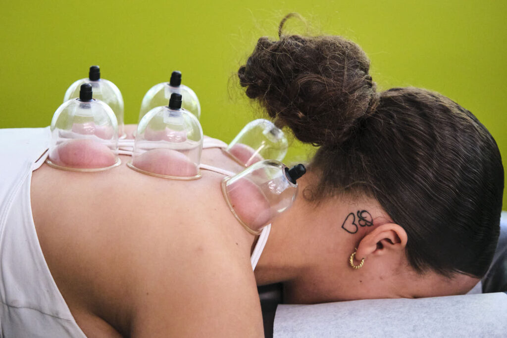 Cupping Therapy in Seattle